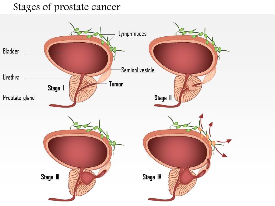 0914 Stages Of Prostate Cancer Medical Images For PowerPoint ...