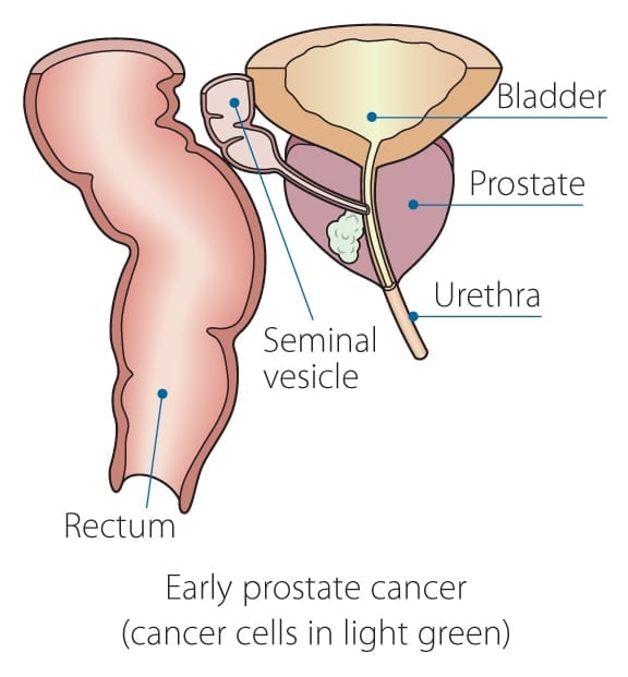10 Best Clinics for Prostate Cancer Treatment in Japan [2020 Prices]