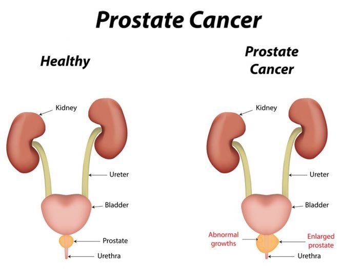 14 Surprising Home Remedies for Prostate Cancer