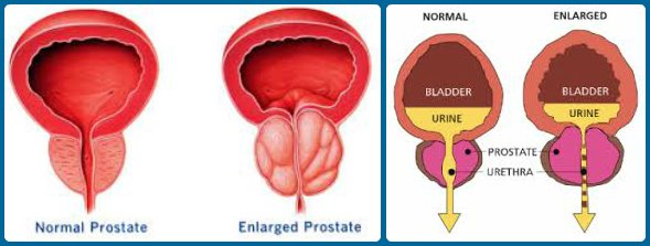 30 Days Natural Solution For EnLarged Prostate And Frequent Urination ...