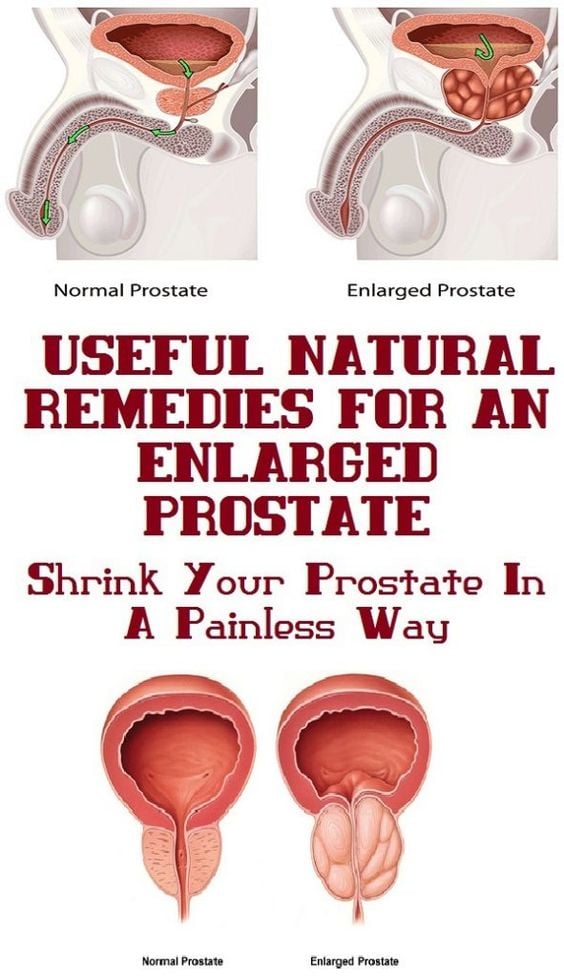 4 Natural Home Remedies For benign prostatic hyperplasia (BPH ...
