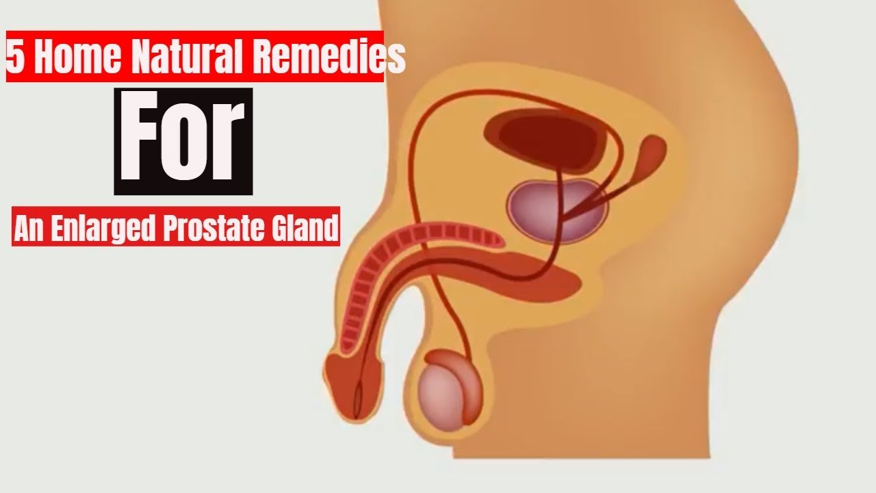 5 Home Natural Remedies for Enlarged Prostate Gland ...