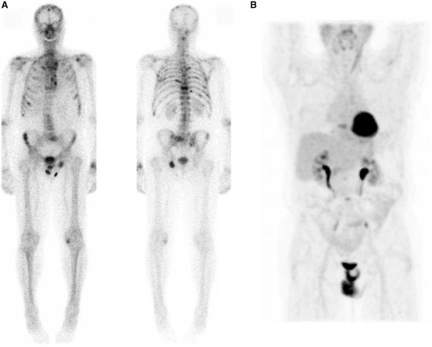 (A) [ 99m Tc]MDP bone scan and (B) FDG