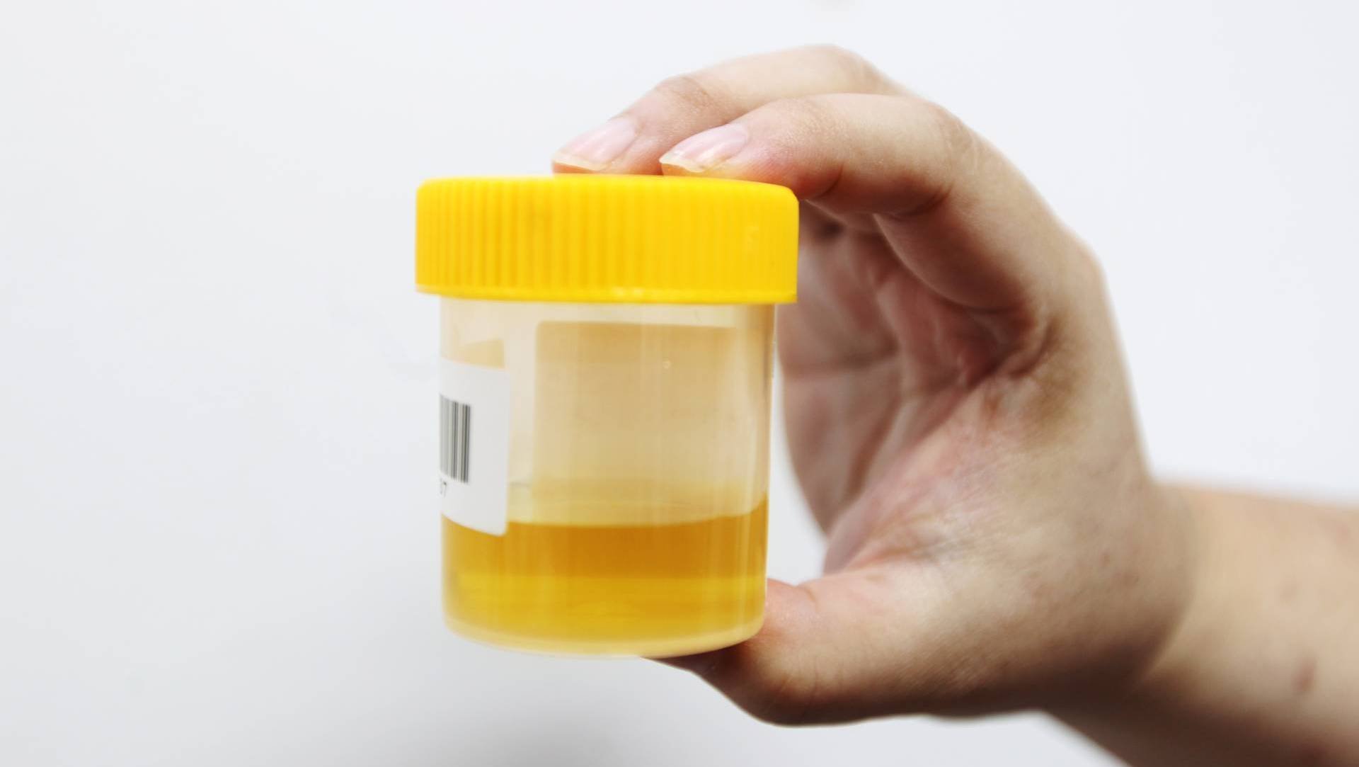 A Urine Test For Prostate Cancer On The Way