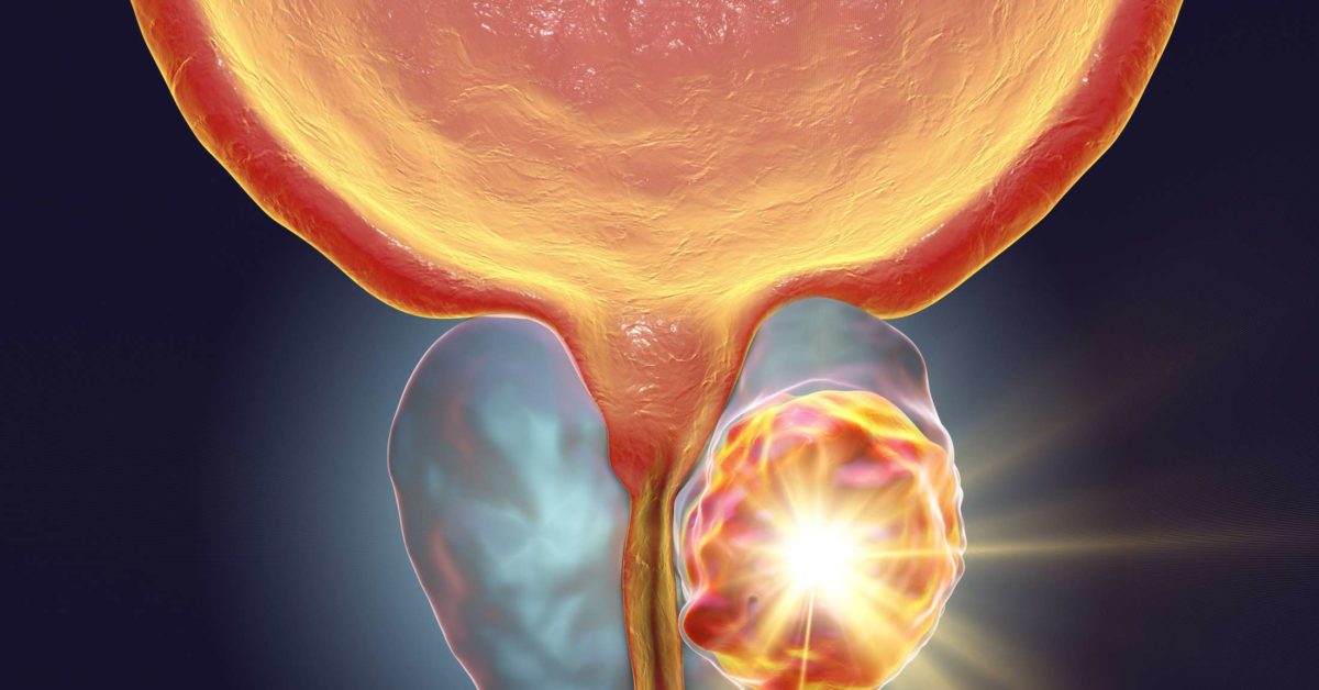 Advanced prostate cancer: Stages, risk factors, symptoms and treatment