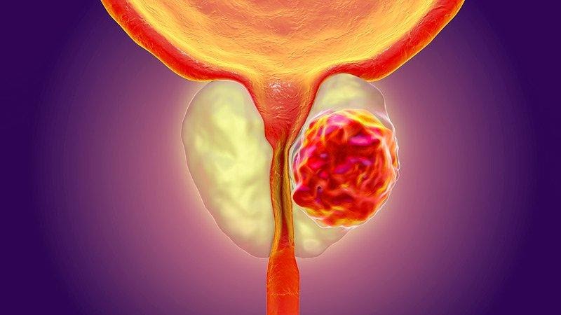 An Insight On Prostate Cancer, Its Causes And Treatment Procedure
