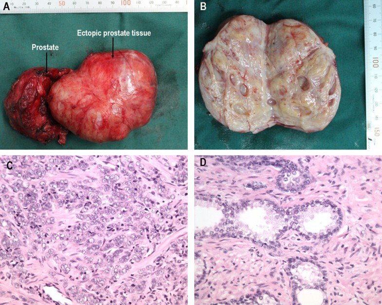 An unusual case of retrovesical ectopic prostate tissue accompanied by ...