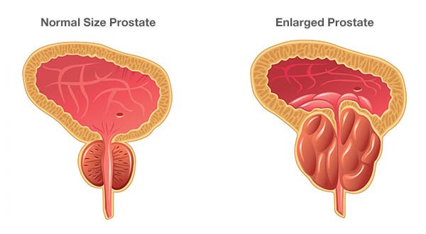 Benign Prostatic Hyperplasia / BPH / Enlarged Prostate Overview ...