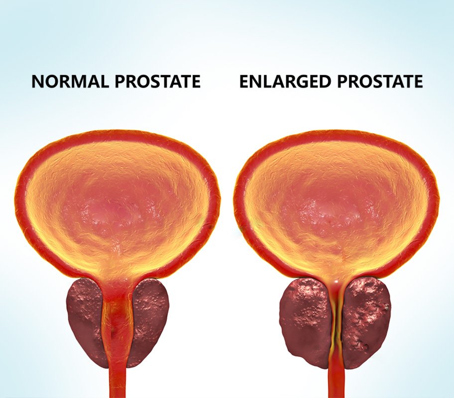 Benign Prostatic Hyperplasia (Enlarged Prostate)