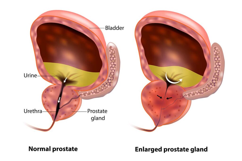 Benign Prostatic Hyperplasia: Symptoms, Causes &  Treatment