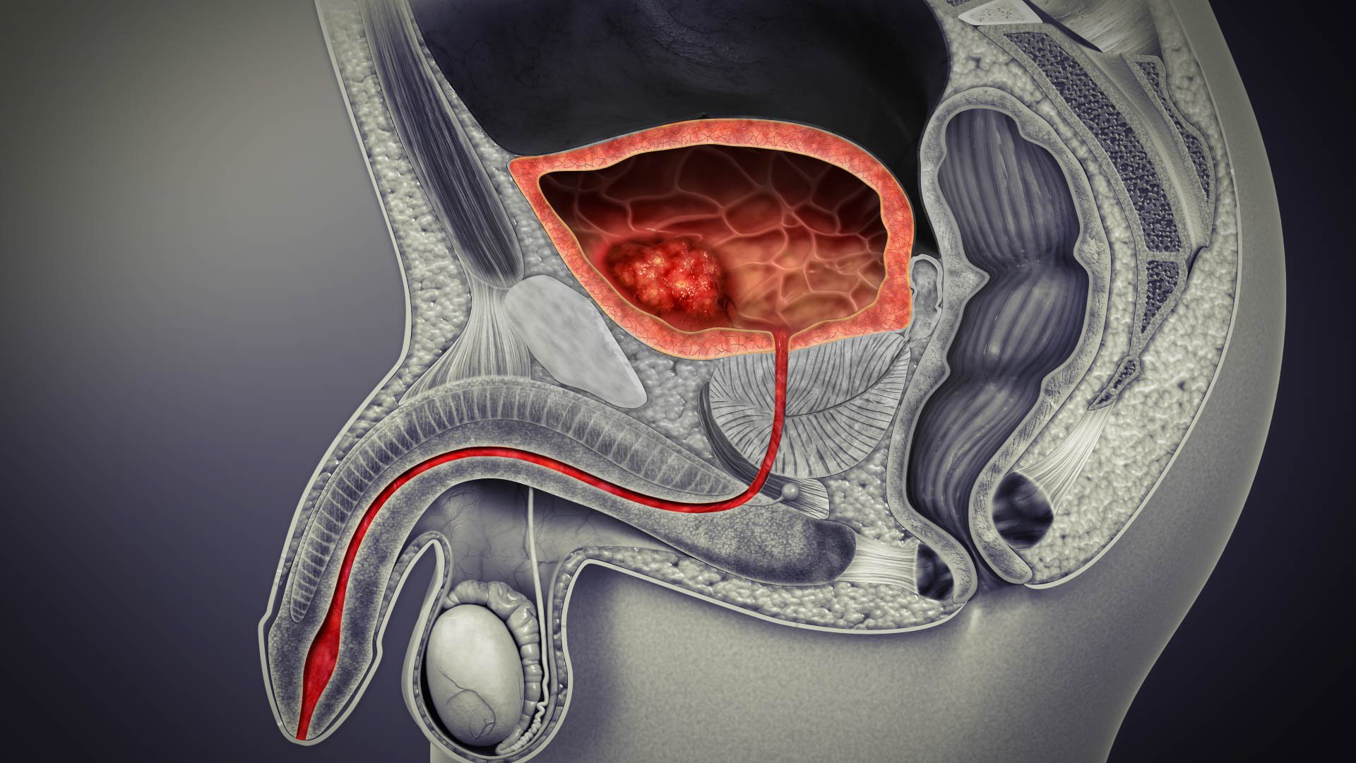 Bladder Cancer: Types, Symptoms, Causes, and Treatment