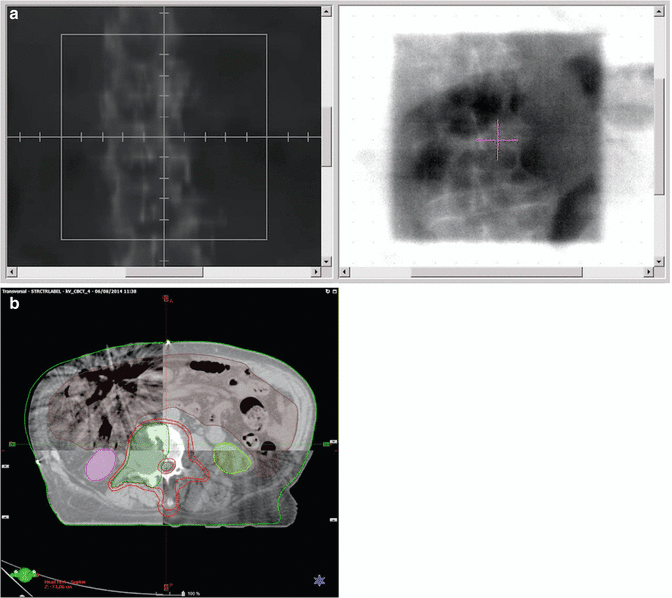 Bone Metastases from Prostate Cancer: Radiotherapy