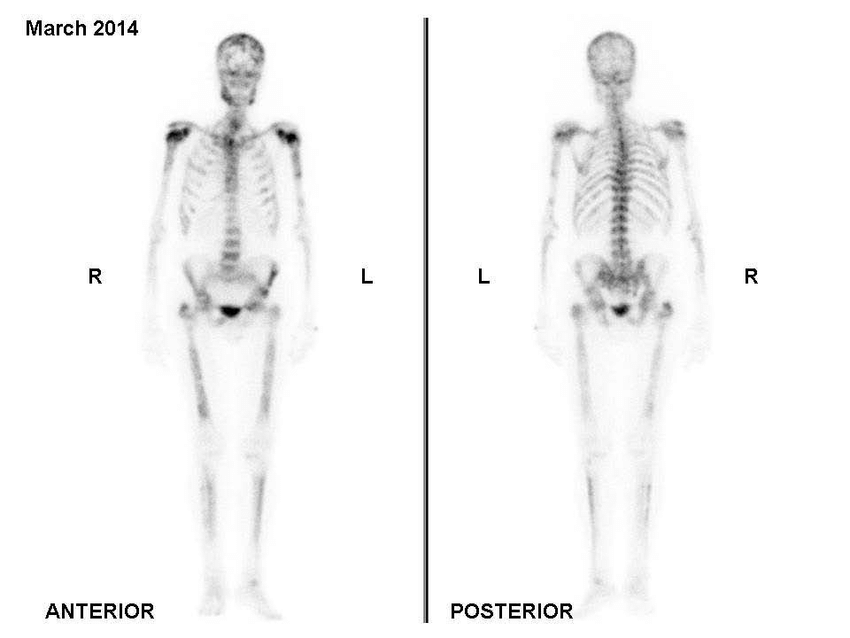 Bone scan performed in March 2014 showing metastatic ...