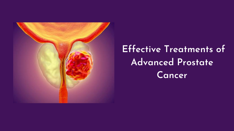 Category: Prostate Cancer Treatment