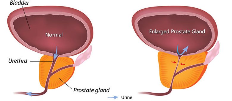Cialis after prostate surgery,When is the best time to ...