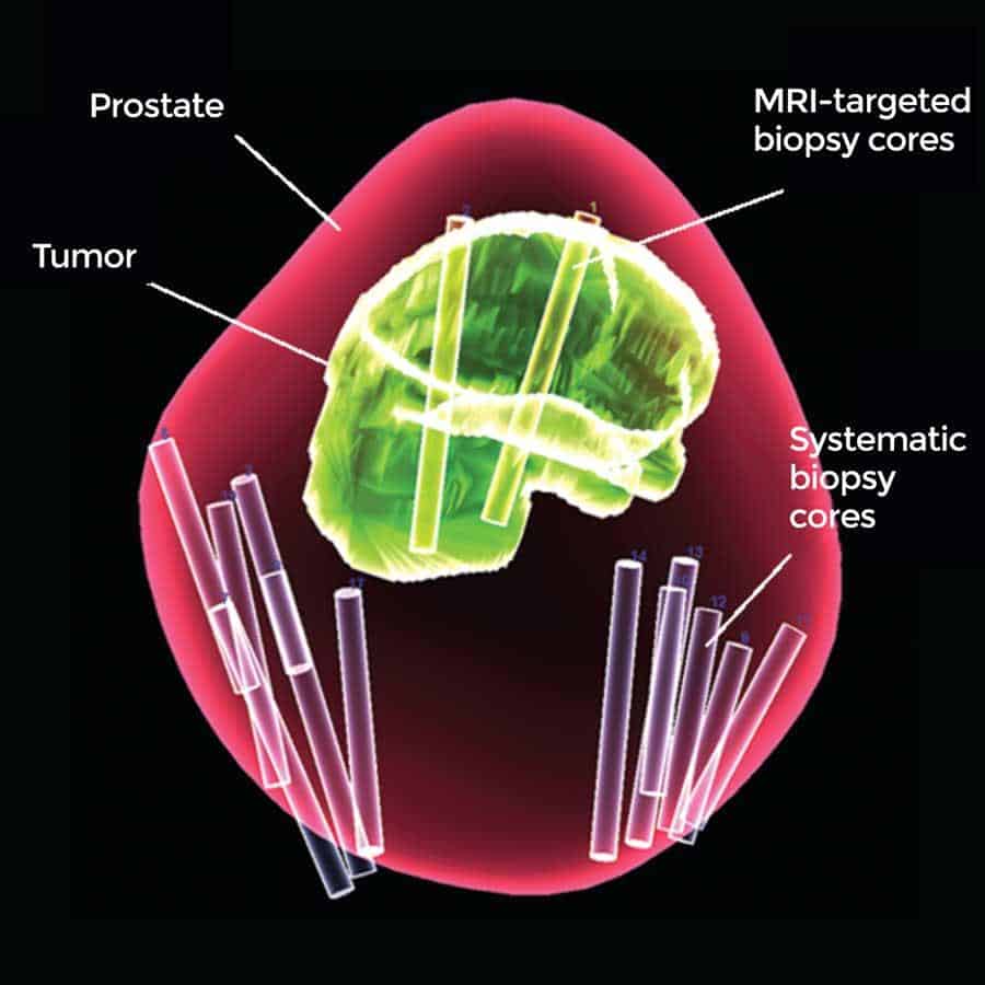Combined biopsy method improves prostate cancer diagnosis