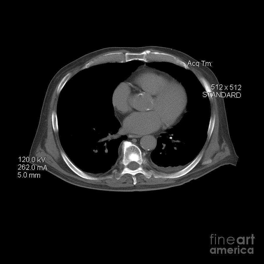 Ct Prostate Cancer Photograph by Medical Body Scans