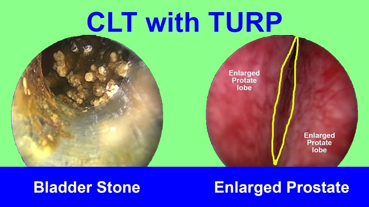 Cystolithotripsy (CLT) with Transurethral Resection of the Prostate ...