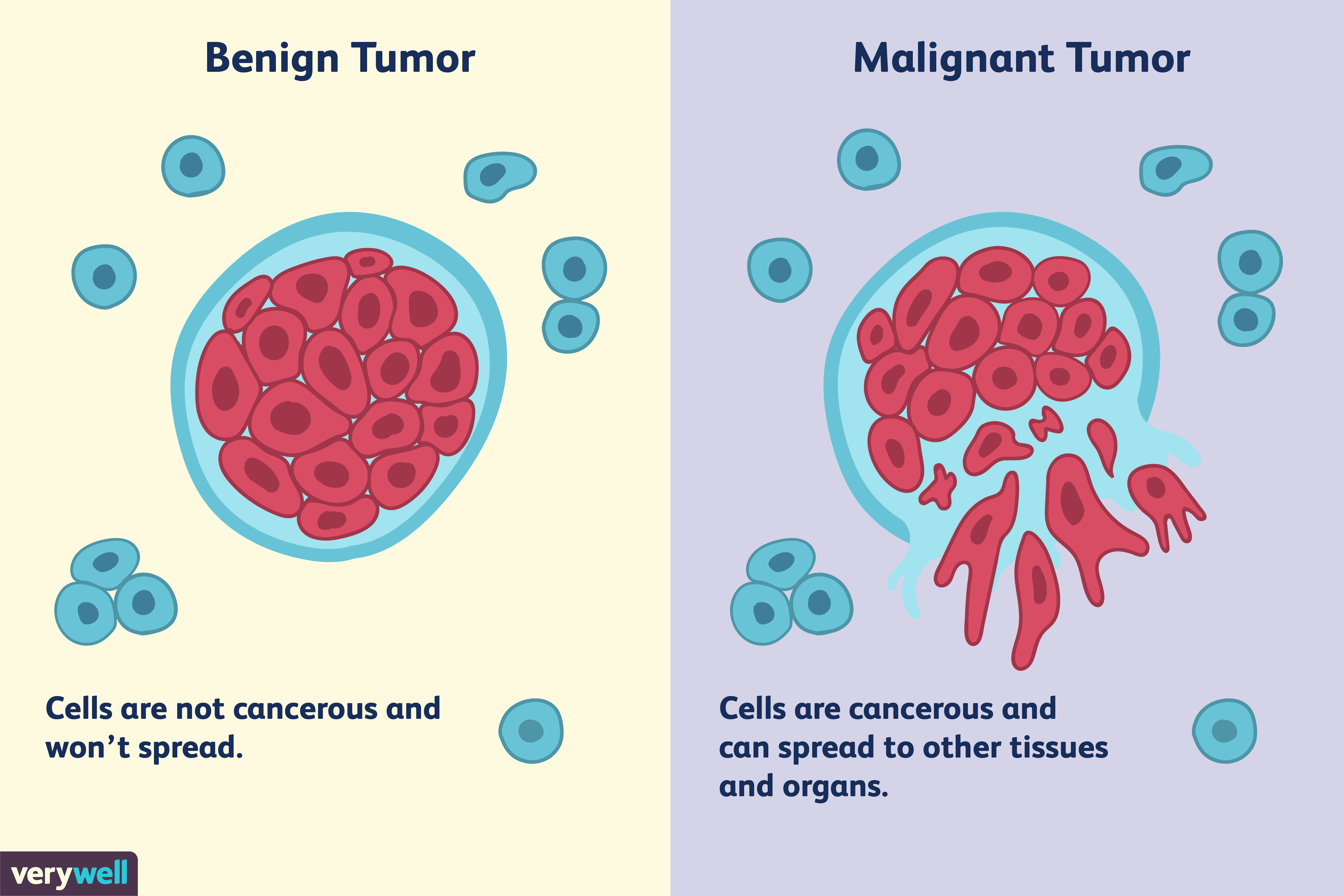 Differences Between a Malignant and Benign Tumor