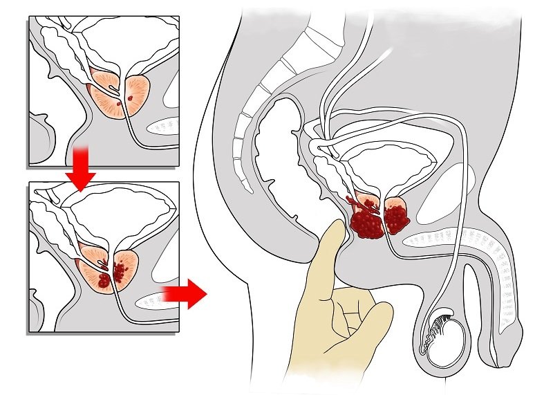 Disease Graphics, Videos &  Images on Prostatitis