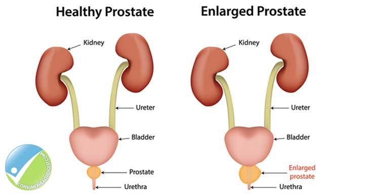 Enlarged Prostate: A Complex Problems with symtons And treatments ...