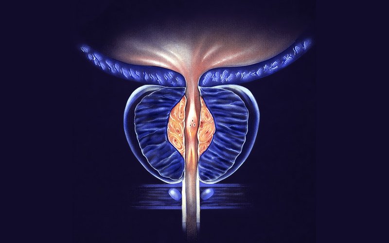 Enlarged Prostate (BPH)