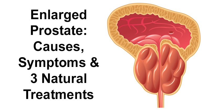 Enlarged Prostate: Causes, Symptoms &  3 Natural Treatments