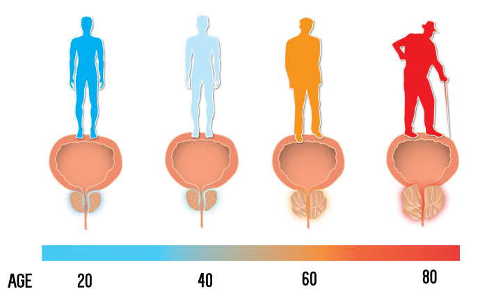 Enlarged Prostate: Everything You Need To Know