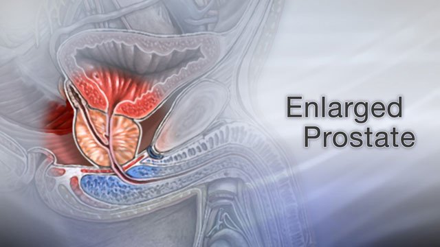 Enlarged prostate Not every man will have to deal with age ...