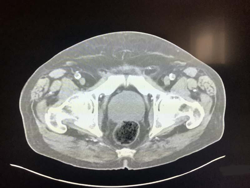 Enlarged Prostate On CT â Radiology In Plain English