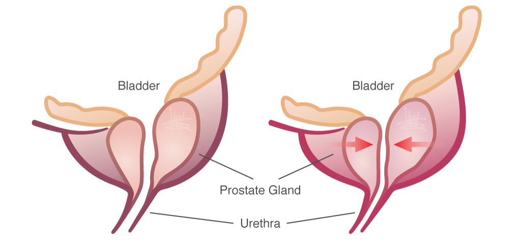 Enlarged Prostate Symptoms and Treatments â ClinicalPosters