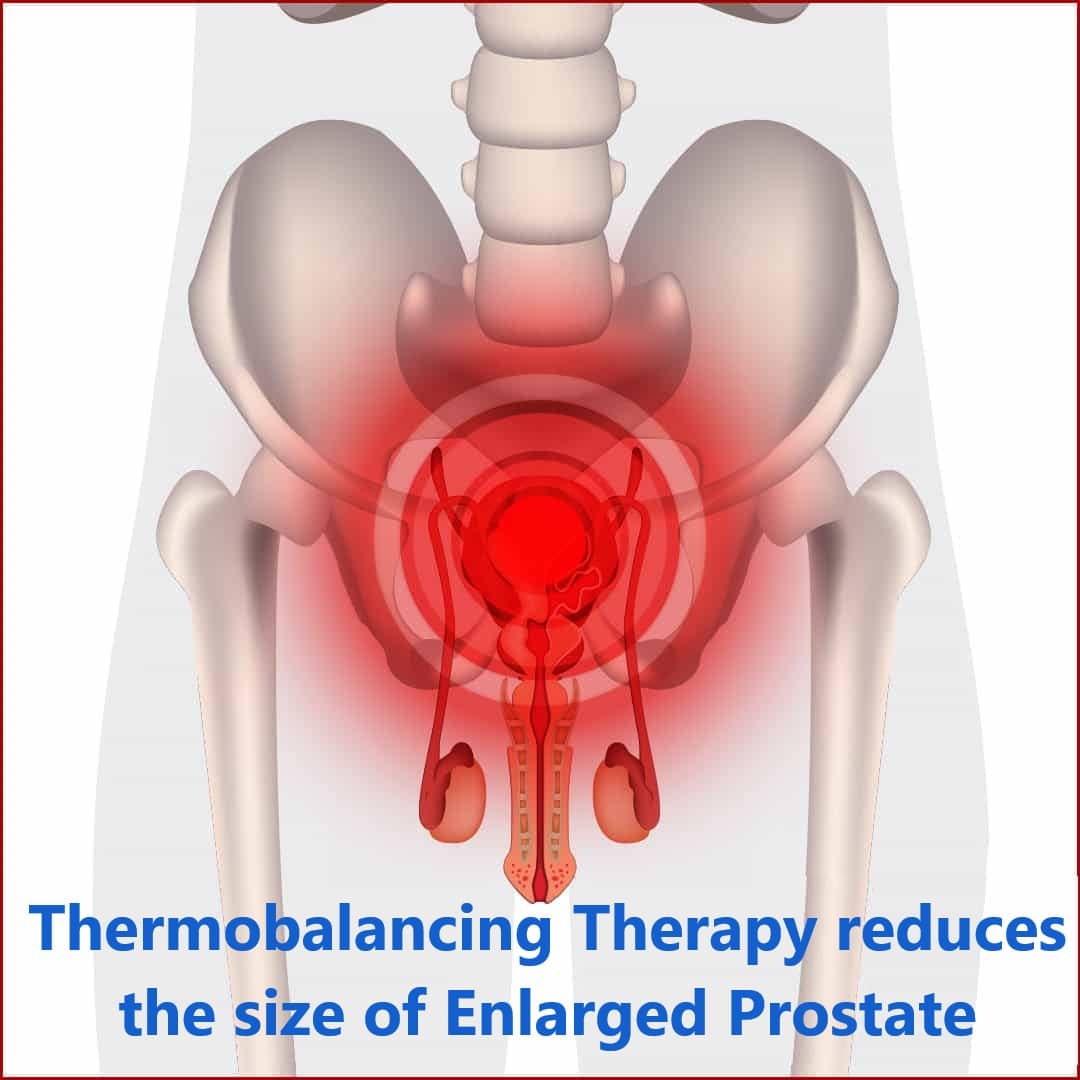 Enlarged Prostate Thermobalancing Treatment Can now Help to Avoid ...