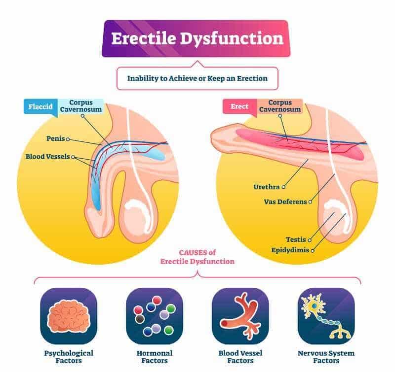 Erectile dysfunction : symptoms, causes, and treatment