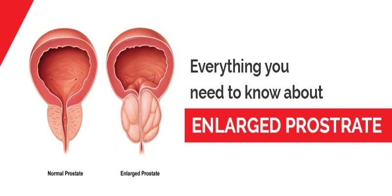Everything You need to know About Enlarged Prostate