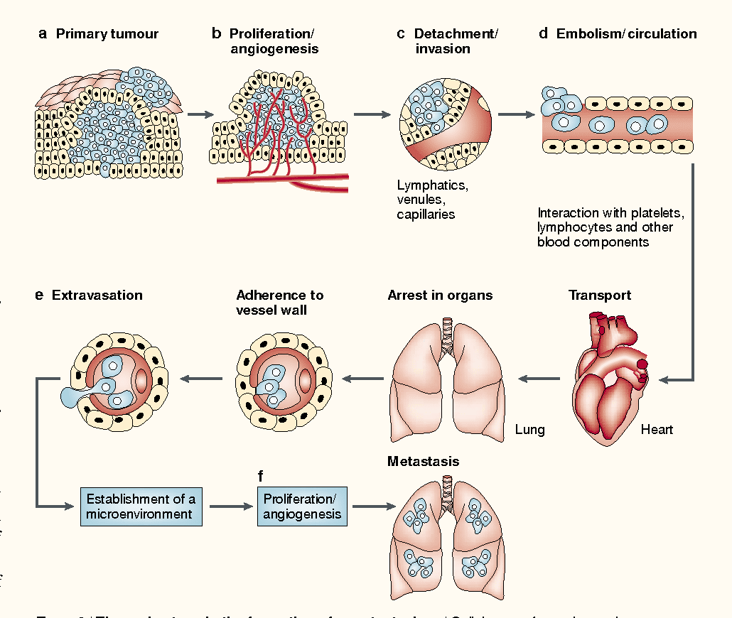 Figure 2 from The pathogenesis of cancer metastasis: the