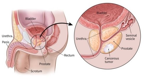Four In Ten Prostate Cancer Cases Are Diagnosed Too Late ...