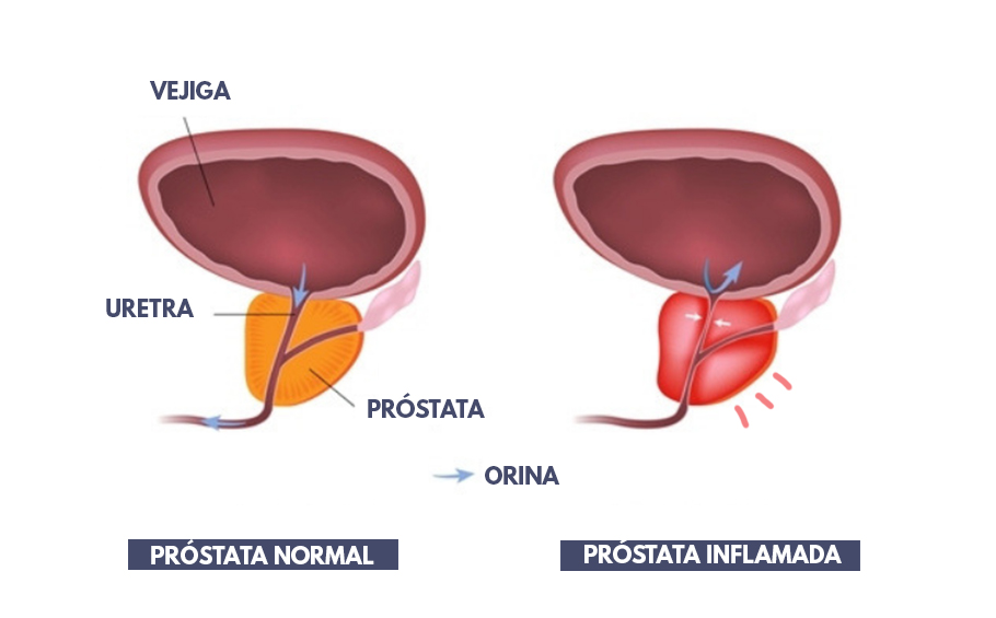 Hiperplasia benigna de próstata (HBP) y prostatitis: Síntomas, difere