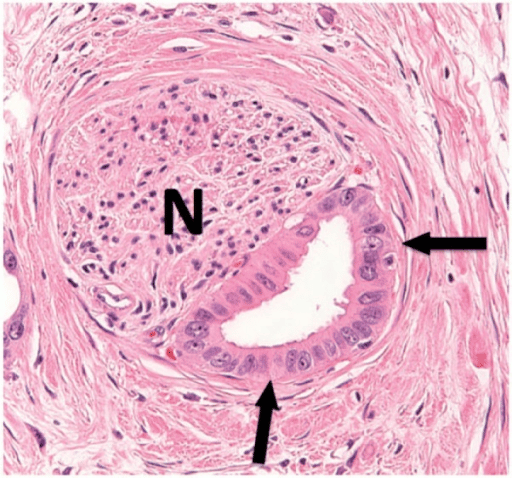 Histological evidence of perineural invasion in a patie