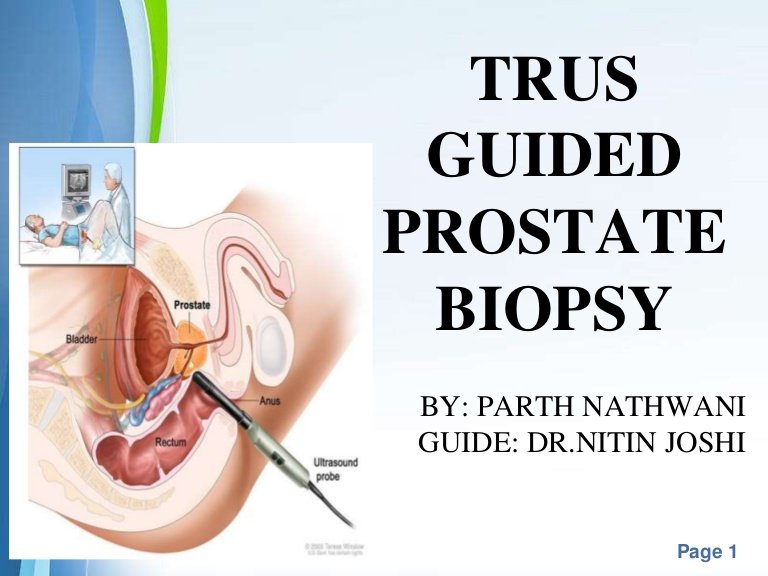How Do They Do A Biopsy On Your Prostate