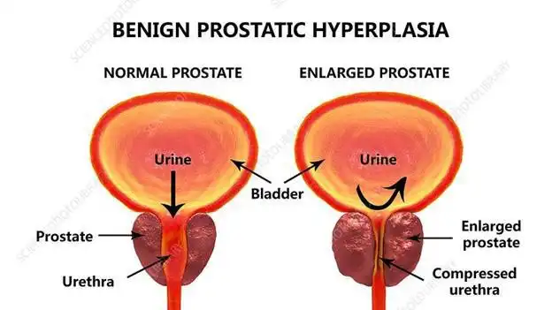 How Do You Know If Your Prostate Is Enlarged