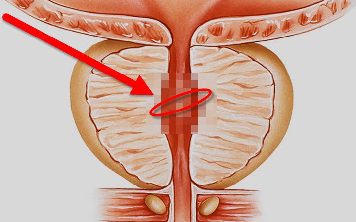 How To Fix Enlarged Prostate (Watch)