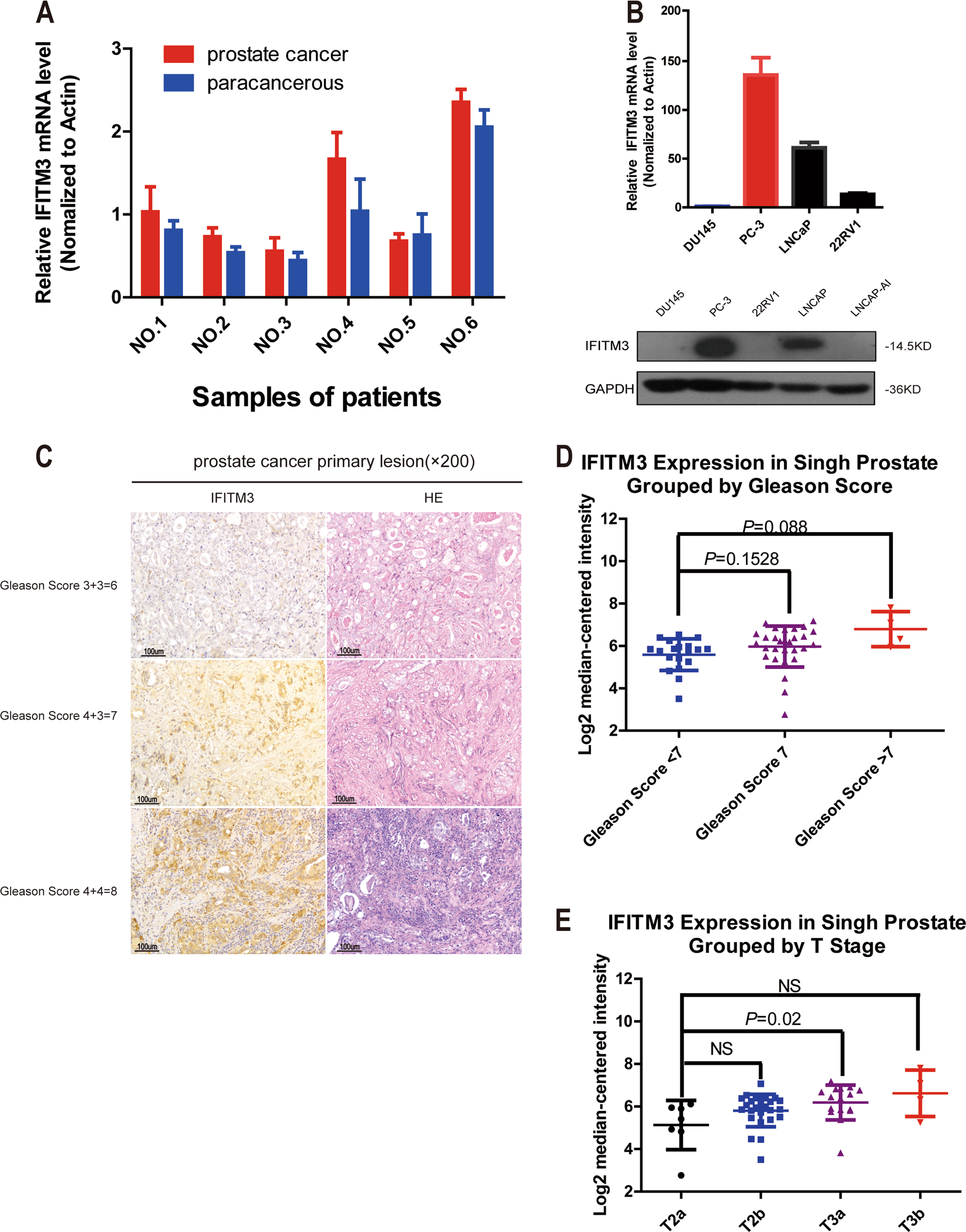 IFITM3 promotes bone metastasis of prostate cancer cells by mediating