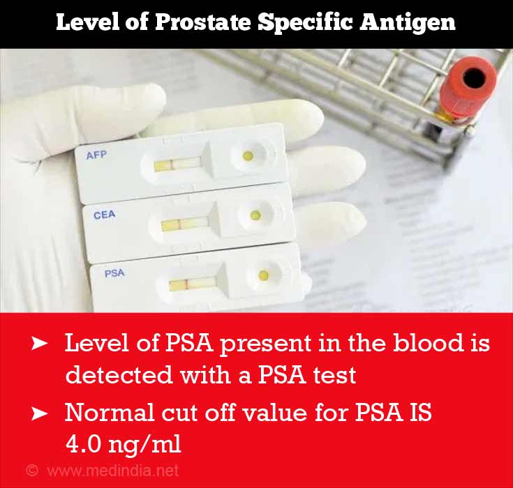 Interpreting PSA values in Prostate Cancer