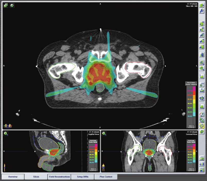 Introduction to Radiotherapy and Brachytherapy