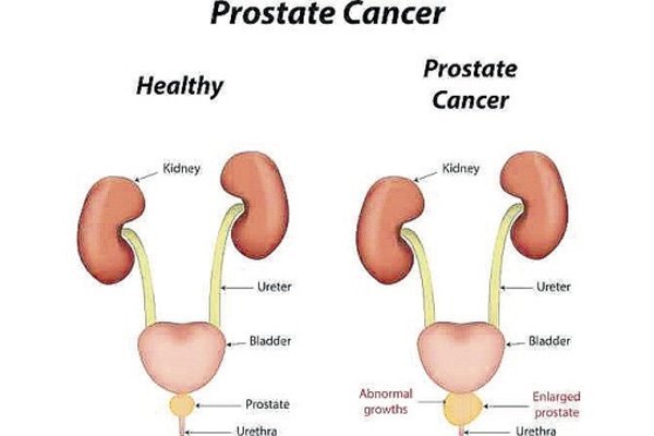 Light therapy and prostate cancer