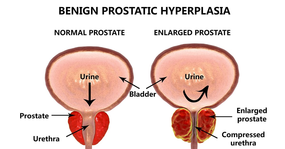 Managing Benign Prostate Hyperplasia &  Peyronieâs Disease: A Urologist ...