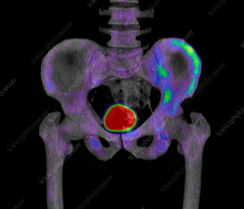 Metastatic prostate cancer, 3D CT and scintigram