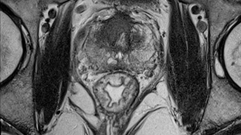 MRI Reliably Identifies Significant Prostate Cancer MRI Reliably ...