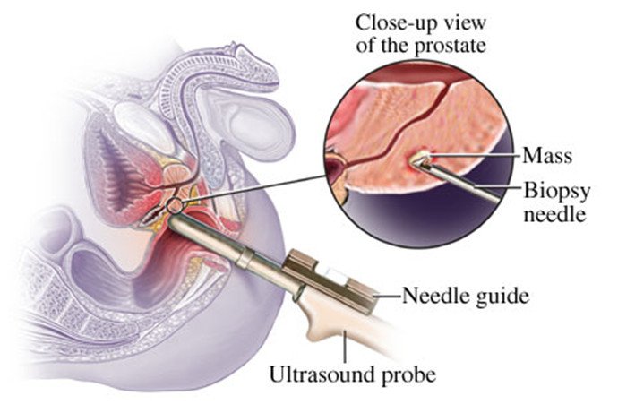 MR/ultrasound fusion guided biopsy of the prostate: a better way to ...