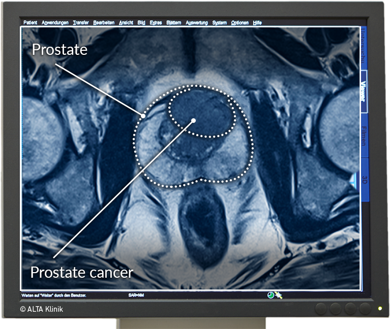 Multiparametric MRI of the Prostate